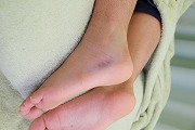 　　　若葉治療院(本院)のブログ-捻挫　足首