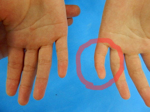 指の曲がり　治す　突き指
