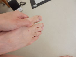 外反母趾│足の親指の付け根の痛み