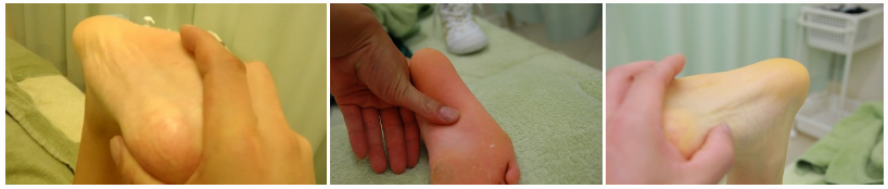足底筋膜炎（足底腱膜炎）のリハビリテーション