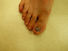 若葉治療院のブログ-足の爪　シューズ