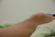 　　　若葉治療院(本院)のブログ-オスグッド　成長痛　膝の痛み　治し方　治療方