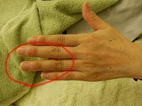 　　　若葉治療院(本院)のブログ-突き指の治し方