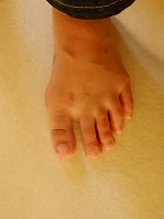 外反母趾　種子骨の痛み　足の裏　手術