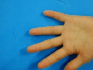指の曲がり　治す　突き指