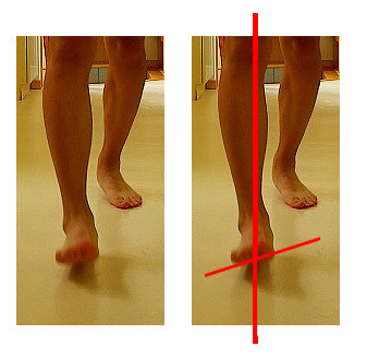 足と歩行の治療　シンスプリント　根本完治