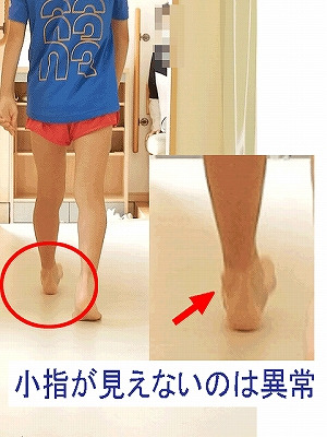 ランニングの痛み：トゥ・インによる踵の痛み　静岡県　富士宮市　若葉治療院本院